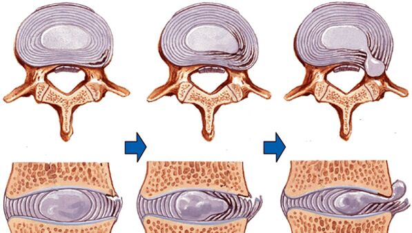 Verletzung vun der Wirbelsäule bei Osteochondrose