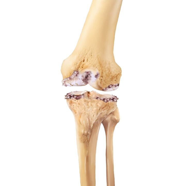 Zerstéierung vum Kniegelenk mat Arthrosis