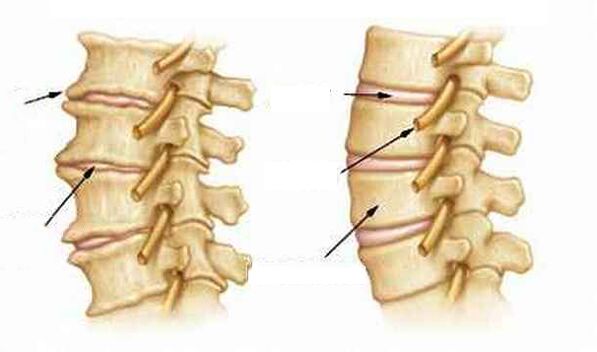 Wat ass Osteochondrosos