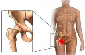 D'Grënn fir d'Entwécklung vu Arthrosis vun der Hüftgelenk