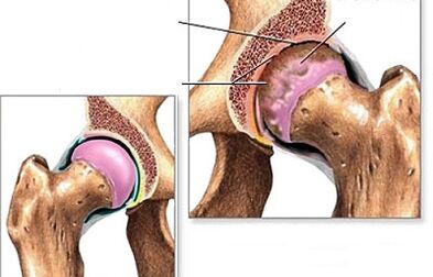 Diagnos vun Hip Arthrosis
