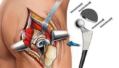 Endoprosthetics fir Hip Arthrosis