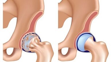 Symptomer vun Arthrosis vum Hip Joint