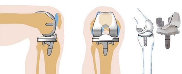 Endoprosthetiker Operatioun vum Knéi Gelenk fir Arthrosis