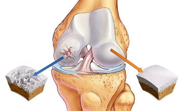 Norm an Ofwäichung fir Arthrosis vum Knéi Gelenk
