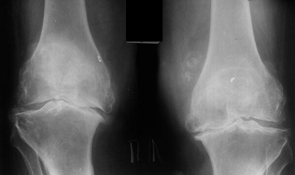 X -ray als e Wee fir d'Arthrosis vum Knéi Gelenk