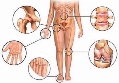 Arthritis an Arthrosis vu verschiddene Gelenker