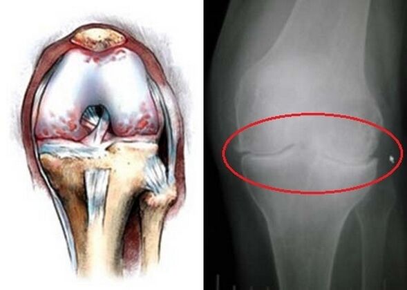 D'Deformatioun vum Knie Gelenk fir Arthrosis