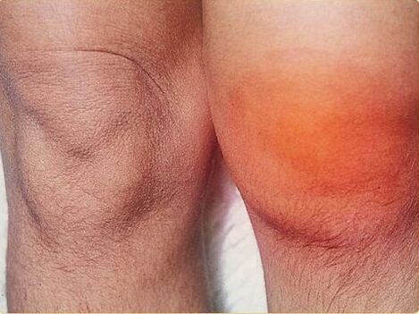 Entzündung vum Kniekelen, déi vun Arthritis betraff sinn