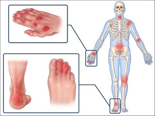 Redness vun der Haut an d'Schwellung vun de Gelenker mat Arthritis