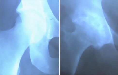 Bild vun der Arthrosis vum Kniegelenk