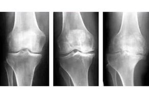 Etappe vun Arthrosis vum Gelenks op enger Röntgenstrahlung